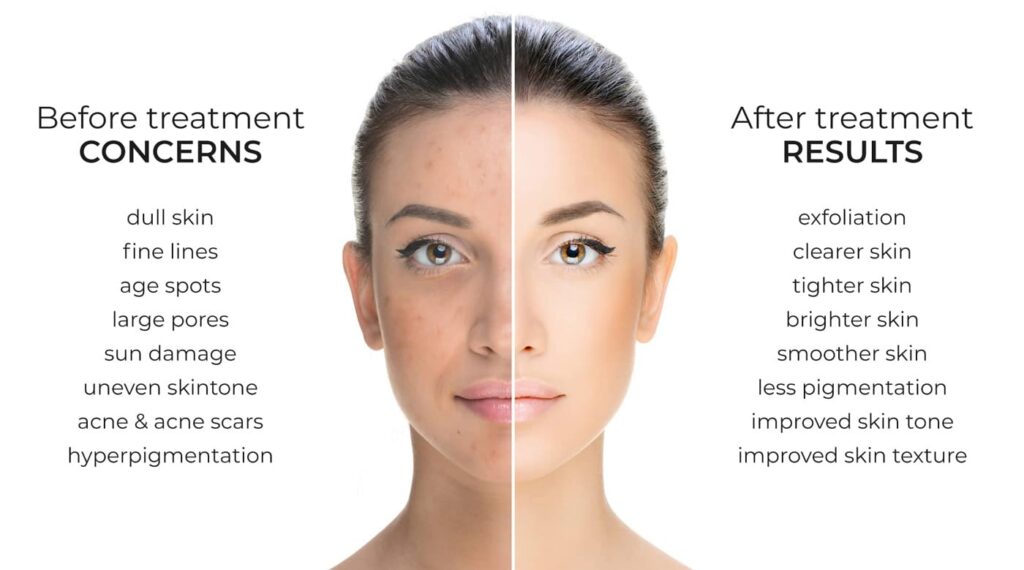 Chemical Peel Treatment Bhopal