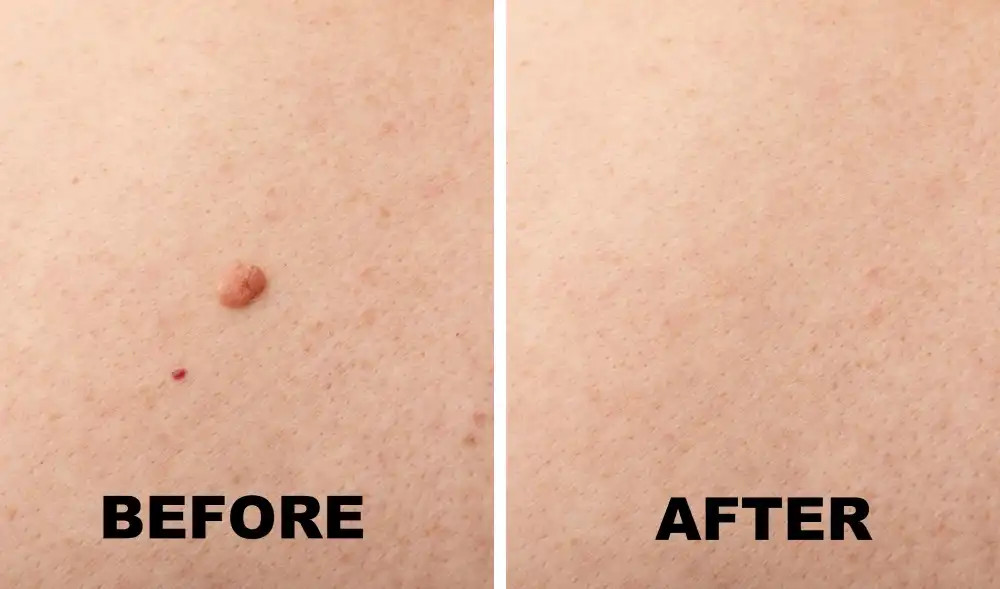 Mole Removal Bhopal